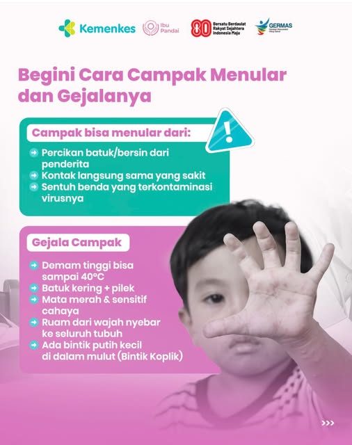 Cara Campak Menular dan Gejalanya